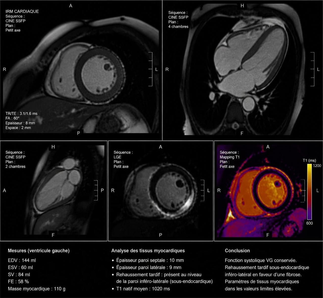 découvrez quand une irm cardiaque devient essentielle pour diagnostiquer et surveiller la santé de votre cœur, afin de prévenir les maladies cardiovasculaires.